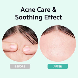 Squid Game X BRINGGREEN Zinc Teca Blemish Serum 25ml + Gonggi